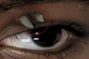 கண் புருவங்களில் திடீரென முளைத்த பல் ; 16 வயது சிறுவனுக்கு பரிசோதனையில் காத்திருந்த ஷாக்