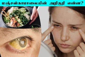 மஞ்சள் காமாலை நோயின் அறிகுறிகள் என்ன? வராமல் தடுப்பது எப்படி?
