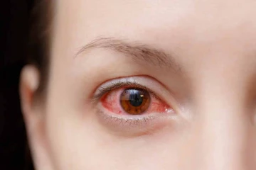 சென்னையில் தீவிரமாக பரவி வரும் மெட்ராஸ் ஐ