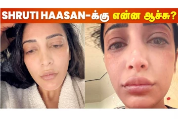 முகம் வீங்கிய நிலையில் ஸ்ருதி ஹாசன்! என்ன ஆச்சு