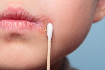 வாய் புண் குணமாக.. இந்த உணவுகளை சாப்பிடுங்க! உடனடி தீர்வை பெறலாம்