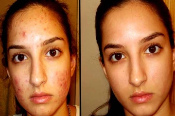 கரும்புள்ளிகளை நொடிப்பொழுதில் விரட்டியடிக்கும் சூப்பரான டிப்ஸ்! நீங்களும் செய்யலாம்..