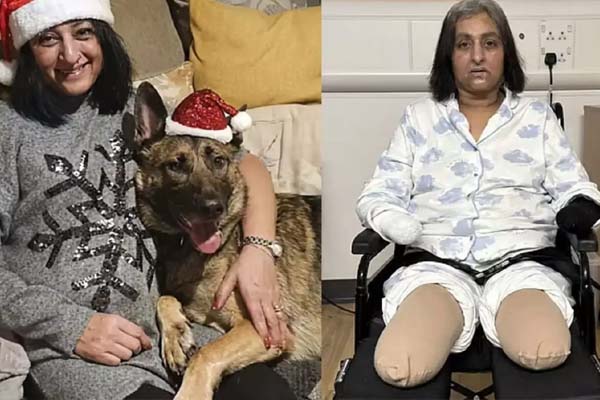 நாய் நக்கியதால் கை கால்களை இழந்த பெண் | Dog Licked Woman Loses Arm And Leg