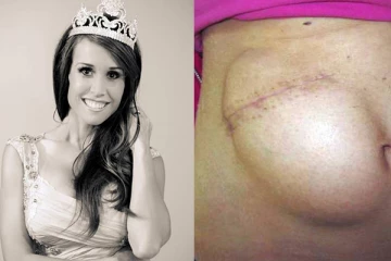 හිස්කබලේ කොටස් ආමාශයේ තැන්පත් කළ අමුතු සැත්කම.