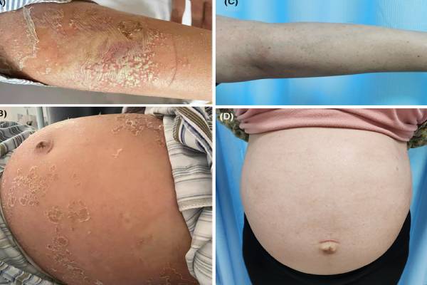 கர்ப்பிணிகளை குறி வைக்கும் சொரியாசிஸ்- எதனால் தெரியுமா? | What Causes Psoriasis In Pregnant Women கர்ப்பிணிகளை குறி வைக்கும் சொரியாசிஸ்- எதனால் தெரியுமா? | What Causes Psoriasis In Pregnant Women
