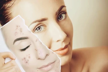 முகத்தில் இருக்கும் கரும்புள்ளி குறைய வேண்டுமா?இதை செய்தால் போதும்