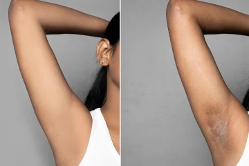 அக்குள் கருமையை எளிய முறையில் வீட்டிலேயே நீக்குவது எப்படி?