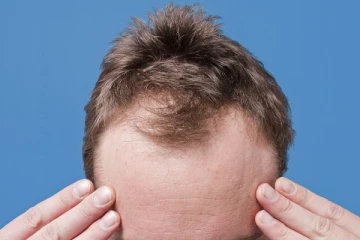 மொட்டை மண்டையிலும் 5 மடங்கு முடி அடர்த்தியாக வளரனுமா? இந்த ஒரே ஒரு பொருள் போதும்