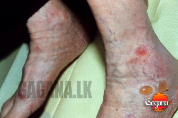 මාරාන්තික රෝගයක් සෑම 5 දෙනෙකුගෙන්ම එක් අයෙකුට දරුවන්ව පරිස්සම් කරගන්න