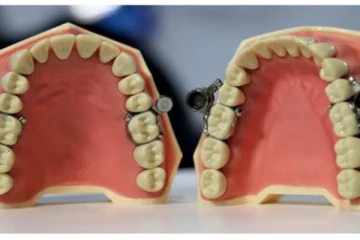 ஜிம்முக்கு போகாமல் உடல் எடையைக் குறைக்க வேண்டுமா? வந்து விட்டது  வாய்க்கு பூட்டுபோடும் புதிய கருவி!