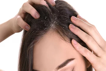 குளிர்காலத்து பொடுகு: 4 ஆயுர்வேத வைத்தியம் செய்தாலே போதும்