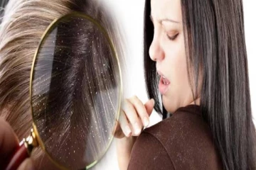 குளிர்காலத்தில் பொடுகு தொல்லை அதிகரித்துவிட்டதா? அப்போ இதை ட்ரை பண்ணி பாருங்க