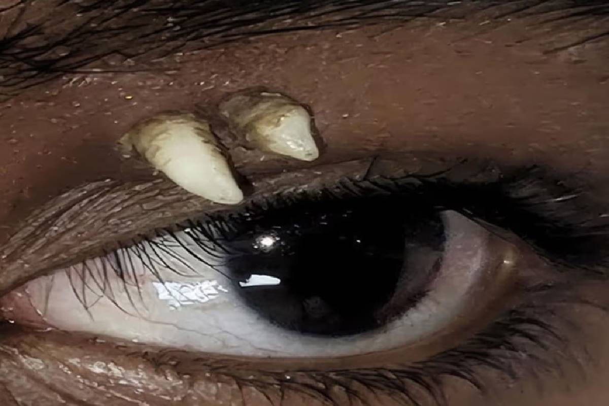 உலகிலே முதல்முறை; இந்திய சிறுவனுக்கு கண்ணுக்கு மேல் வளர்ந்த பல் | Indian Teen Only Patient With Tooth In Eye Socket உலகிலே முதல்முறை; இந்திய சிறுவனுக்கு கண்ணுக்கு மேல் வளர்ந்த பல் | Indian Teen Only Patient With Tooth In Eye Socket