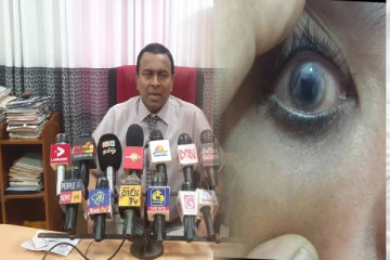 வடக்கில் பார்வை இழந்த சிறுவர்கள் :காரணத்தை வெளியிட்ட வைத்திய நிபுணர்