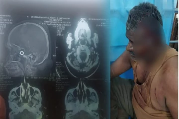 தலையில் நட்டோடு தையல் போட்ட அரசு மருத்துவமனை செவிலியர்கள்..!