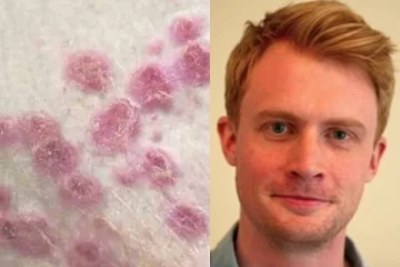 Monkeypox தொற்றை ஒருபோதும் ஒழிக்க முடியாது: பிரித்தானிய நிபுணர் விடுக்கும் எச்சரிக்கை