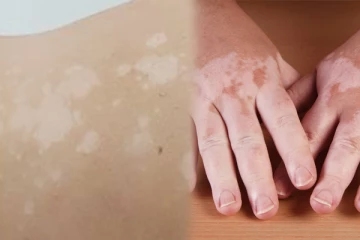 உடம்புல வெள்ளையா தேமல் இருக்கா? இத மட்டும் ட்ரை பண்ணுங்க!