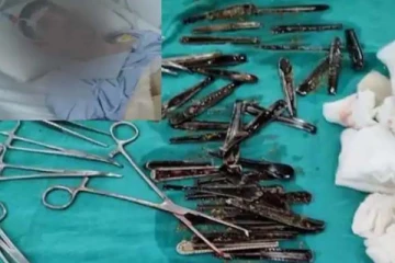 இளைஞரின் வயிற்றில் 63 ஸ்பூன்கள்.. திகைத்து நின்ற மருத்துவர்கள்! வெளியான அதிர்ச்சி காரணம்