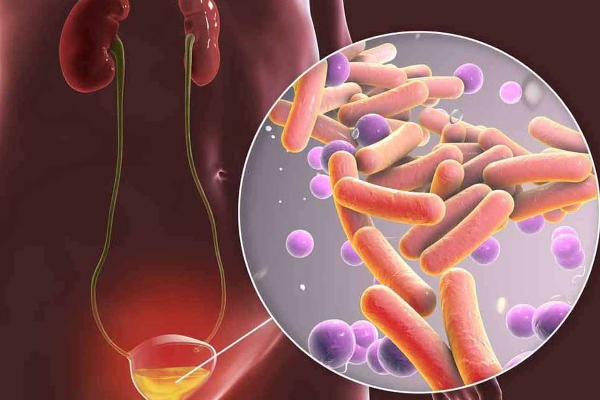 Urinary tract infection (UTI) visual data 5