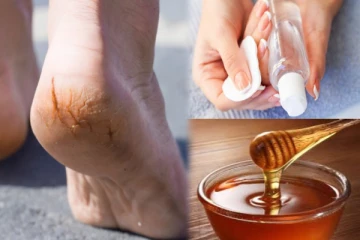 குதிகால் வெடிப்பை நீக்கி பாதங்களை அழகாக்க இந்த இரண்டு பொருட்கள் போதும்