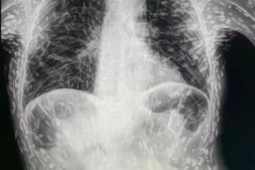 இருமல் சிகிச்சைக்கு வந்த நபருக்கு ஸ்கேன் செய்தபோது திகிலடைந்த மருத்துவர்கள்!