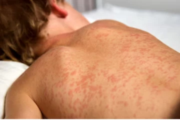 கனடாவின் ஆல்பர்ட்டா மாகாணத்தில் தட்டம்மை பரவல்