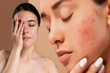 மாதவிடாய் காலத்தில் அதிக முகப்பரு பிரச்சினையா? வீட்டிலேயே குணப்படுத்தும் வீட்டு வைத்தியம்