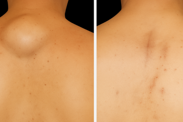 තෙල් ගෙඩි වලට භය වෙන්න ඕනෙද? | Do Lipomas Pose Any Health Risks