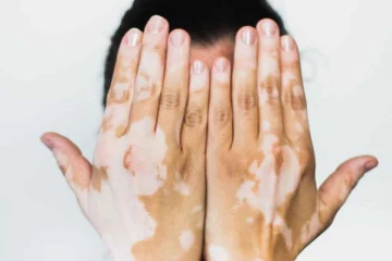 சருமத்தில் திடீரென தோன்று தேமலை விரைவில் விரட்டனுமா?