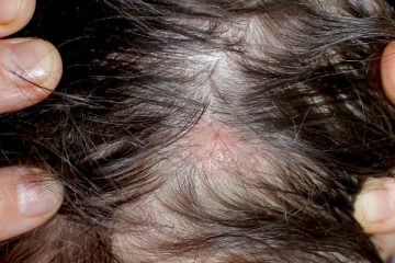 முடி ரொம்ப அடர்த்தியா வளரணுமா? கண்டதையும் தேய்க்காம இந்த ஒரு பொருள மட்டும் போடுங்க!