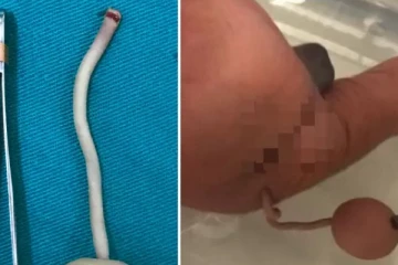 வாலுடன் பிறந்த குழந்தை .. ஆச்சரியமடைந்த மருத்துவர்கள் : வைரலாகும் புகைப்படம்