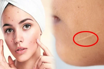 முகத்தில் அதிக தழும்பு இருக்கா? இப்படி செய்து பாருங்க