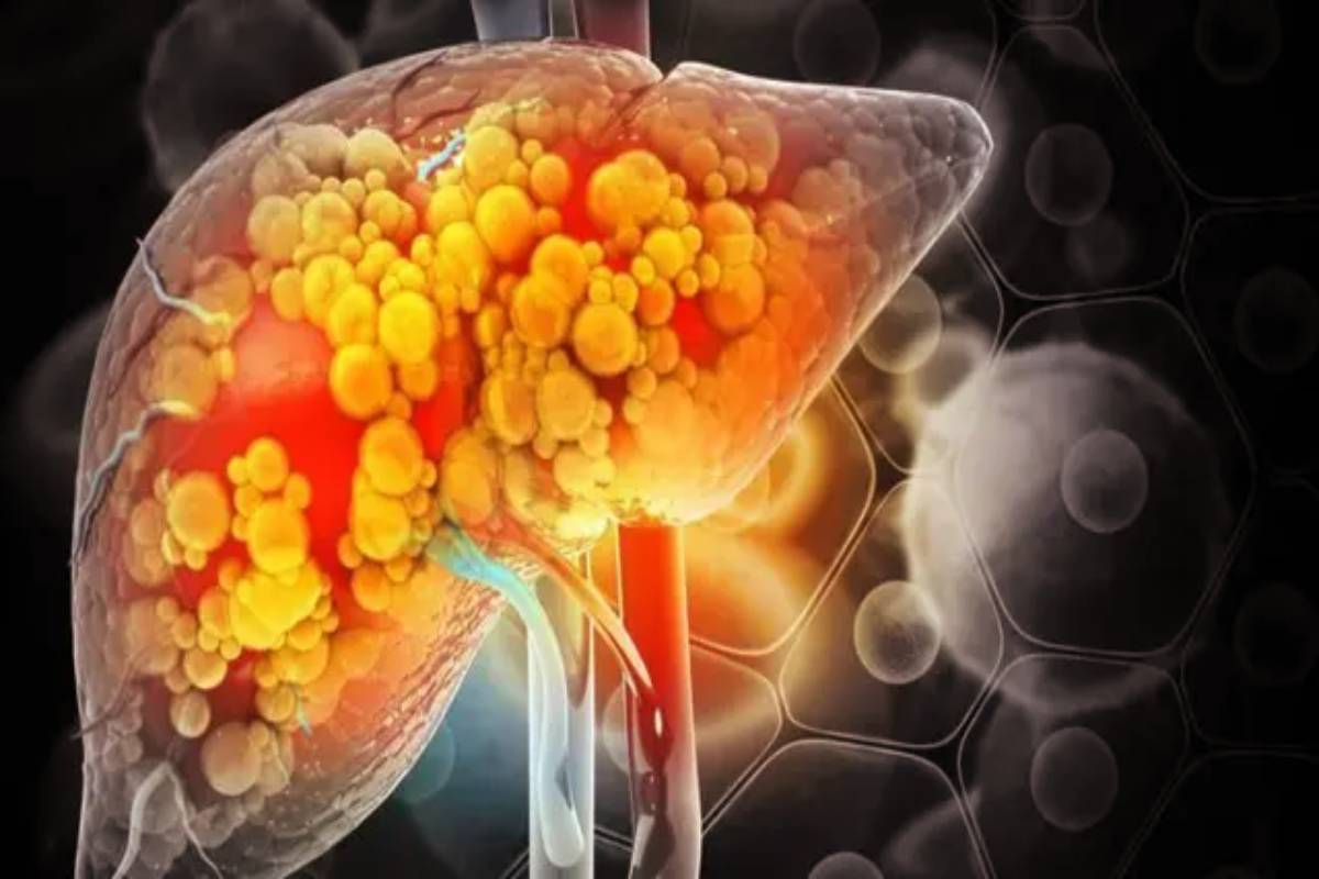 உள்ளங்கையில் இந்த அறிகுறி இருக்கா? கல்லீரல் பத்திரம் | Palm Symptom Of Liver Damage Doctors Warn