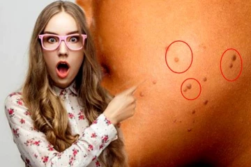 மருக்களை தடம் தெரியாமல் போக்க வேண்டுமா? இதோ சூப்பரான சில டிப்ஸ்