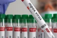 ஜேர்மனியில் பதிவான முதல் புதிய வகை Mpox வைரஸ்: பரவல் முறை, அறிகுறிகள் என்னென்ன?