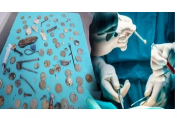 ஒருவரது வயிற்றுக்குள் கிடந்த ஊசி... கூக்கு... காசு பொருட்கள் - உயிரை காப்பாற்றிய மருத்துவர்கள் - அதிர்ச்சி சம்பவம்