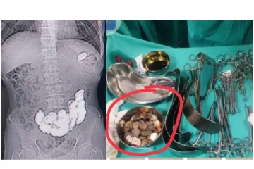 187 நாணயங்களை விழுங்கிய முதியவர்...! - வயிற்றை கிழித்து கொத்துக்கொத்தாக அகற்றிய மருத்துவர்கள்...!