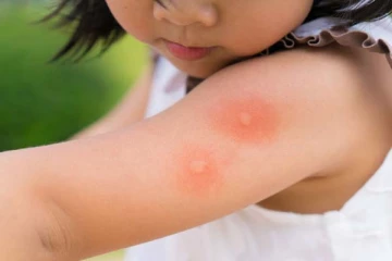 பூச்சி கடித்தால் உடனே என்ன செய்ய வேண்டும்? வீட்டில் இருக்கும் இந்த பொருட்களே போதும்