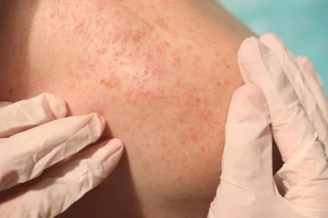 கோடைக்காலத்து விருந்தாளியான வியர்குருவை எப்படி சமாளிப்பது?