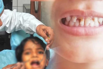 நாட்டில் சிறுவர்களிடையே பல் நோய்கள் அதிகரிப்பு: விடுக்கப்பட்டுள்ள கோரிக்கை