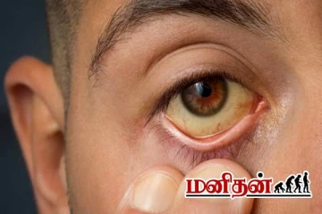 மஞ்சள் காமாலை நோய்: மருத்துவரின் விரிவான விளக்கம்