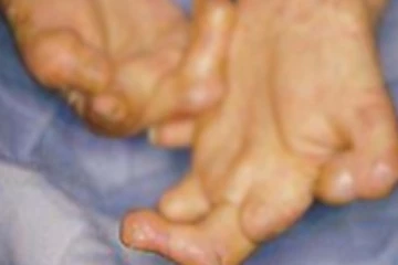 මෙරට ළමයින් අතර රෝගී තත්ත්වයක් ඉහළ යයි..