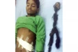 இளைஞரின் வயிற்றிலிருந்து இரட்டைக் கரு அகற்றம்