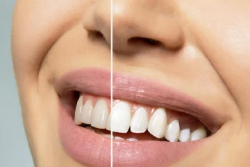 ඔබේ දතුත් අදුරු වෙලාද දත් සුදු කරන ක්‍රම කිහිපයක් මෙන්න...