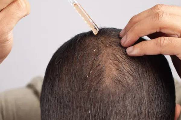 வழுக்கையான இடத்தில் 20 நாட்களில் முடி வளரும் சீரம் - ஆய்வாளர்கள் கண்டுபிடிப்பு | Serum Forhair Growth In Bald Areas In 20 Days