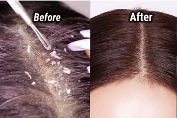 டாக்டர் யோக வித்யா: வெங்காய சாறை இப்படி போட்டால் பொடுகு கொஞ்சம்கூட இருக்காது