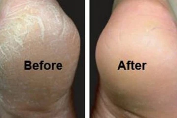 15 நிமிடங்களில் குதிகால் வெடிப்பைப் போக்க வேண்டுமா? இதோ சூப்பரான டிப்ஸ்