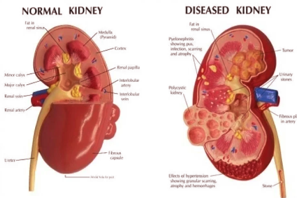 சிறுநீரக பாதிப்பின் முன்கூட்டிய அறிகுறிகள் - நிபுணர்களின் விளக்கம் | Early Signs Of Kidney Damage Don T Ignore It சிறுநீரக பாதிப்பின் முன்கூட்டிய அறிகுறிகள் - நிபுணர்களின் விளக்கம் | Early Signs Of Kidney Damage Don T Ignore It