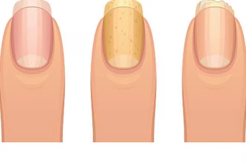 නියපොතු කහ පාට වීමෙන් පෙන්නුම් කරන වෙනත් රෝග ලක්ෂණ.