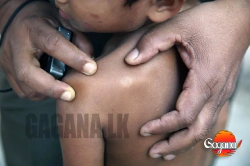 නැවතත් අතිශය භයානක රෝගයක් හිස ඔසවයි වැඩි ප්‍රමාණයක් දරුවන්